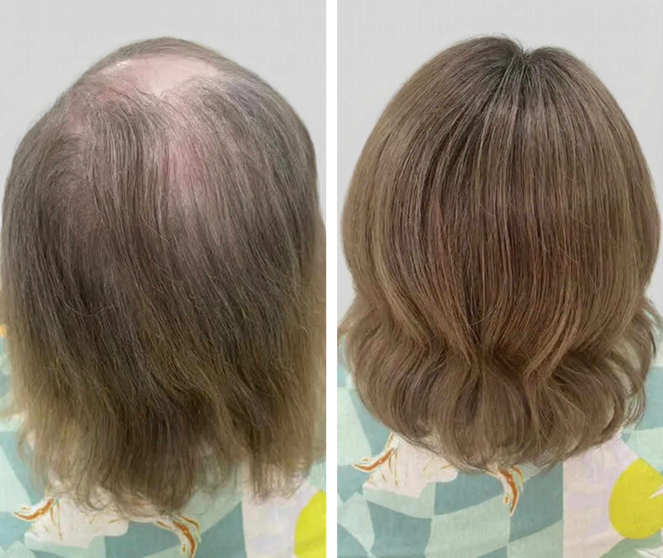 Natural-looking volume and coverage for thinning crown area.